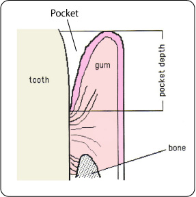 gum disease